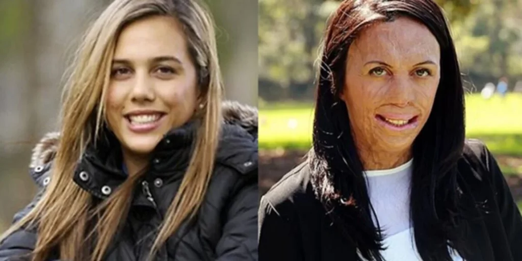 Turia Pitt Accident Video and Her Life Journey Explained