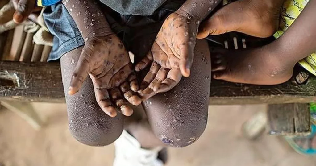 Tecovirimat Can be the Cure for Monkeypox